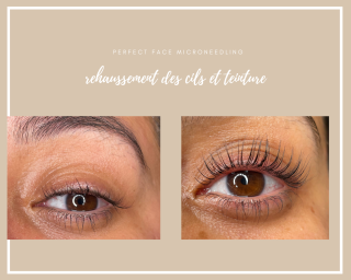 Salon de Manucure Perfect face microneedling 0